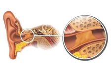 Çocuklarda Kulak Kiri Belirtileri ve Tedavisi Çocuklarda Kulak Kiri Belirtileri ve Tedavisi