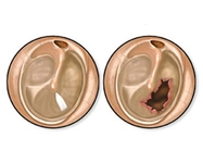 Kulak Zarı Delinmesi Belirtileri ve Tedavisi Kulak Zarı Delinmesi Belirtileri ve Tedavisi