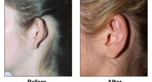 Ameliyatsız Kulak Estetiği