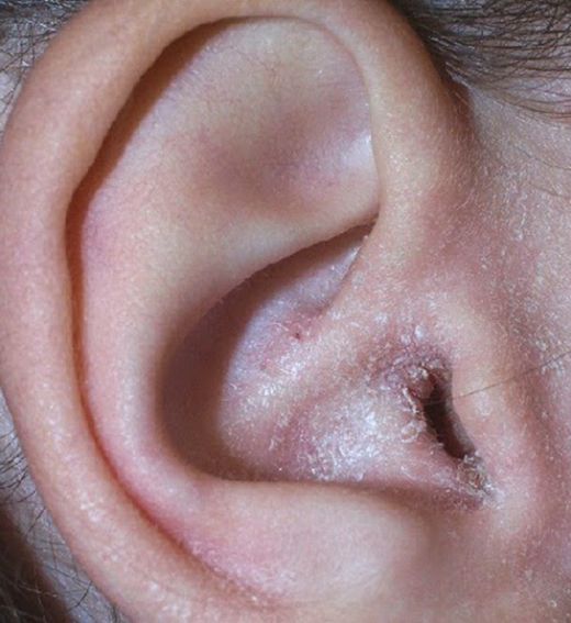 Kulak Mantarı Bitkisel Çözüm
